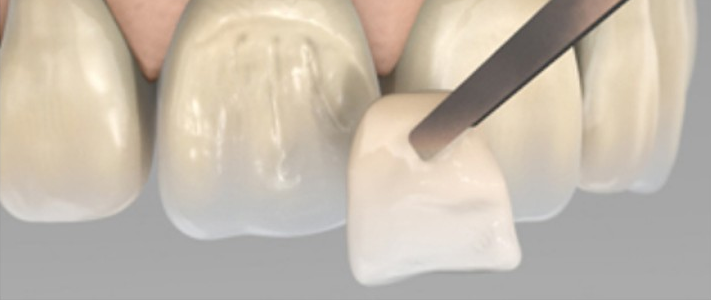 Composites de recubrimiento